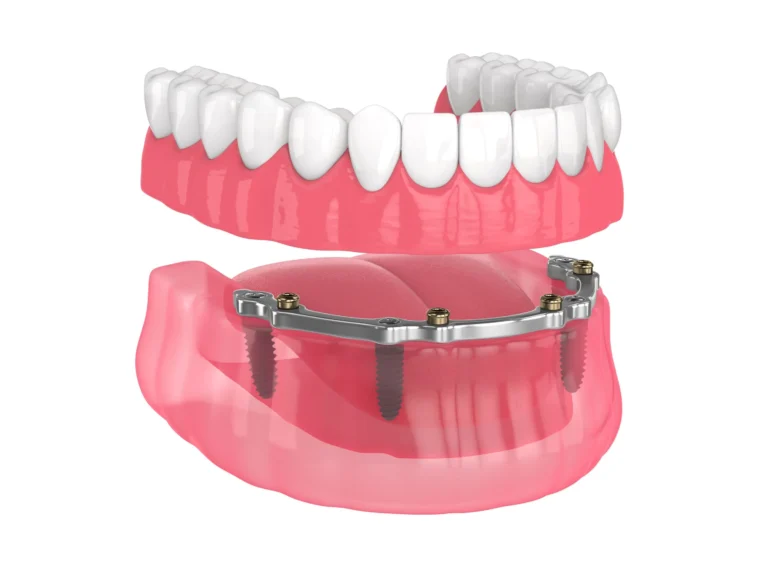 Implant Gigi Indramayu
